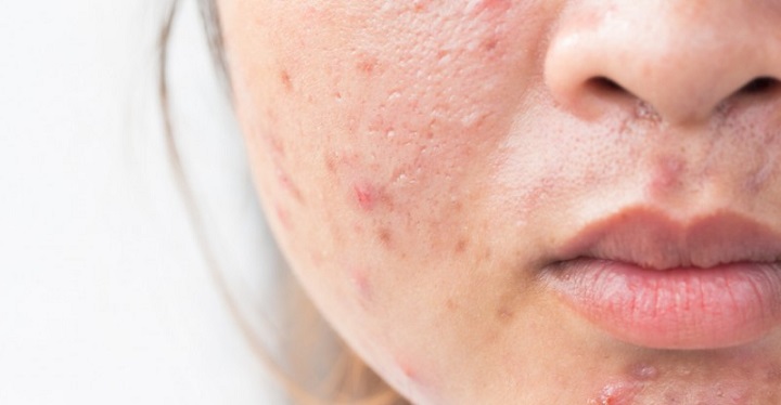 Bạn đã biết cách chăm sóc da sau nặn mụn chưa?